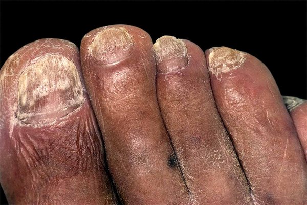 Not to be used for advertising or in a defamatory context
Toenail of a male patient with a fungal infection. Known as onychomycosis, or tinea unguium, this condition can be caused by various fungi. Treatment is with antifungal creams or drugs.